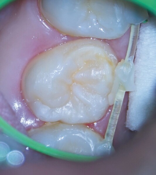 Fig. 5a : Deux semaines après l’intervention. Un tissu parodontal sain est visible autour de la dent transplantée, (a) avant et (b) après le retrait de la contention. 