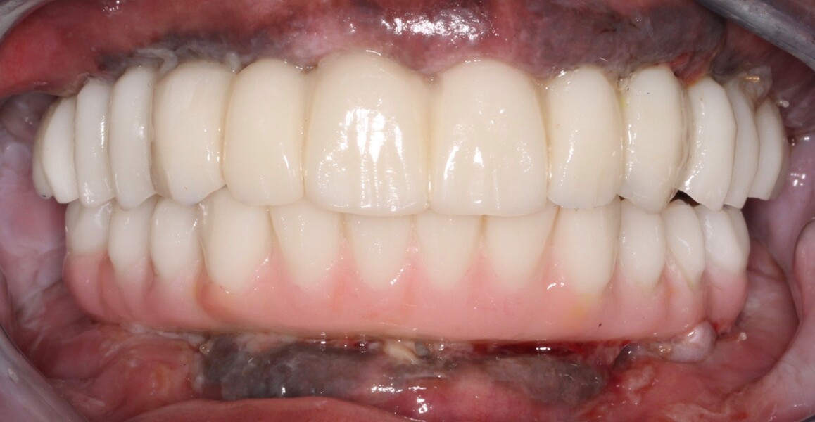 Fig. 17: Complete maxillary and mandibular Flexcera Smile transitional prostheses, one day after surgery.