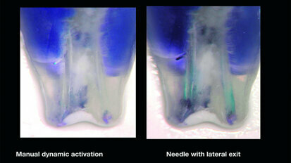 The effect of partial vacuum on the chemical preparation of the root canal system
