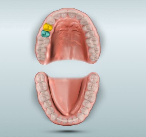 Fig. 2: MyCrown view of the concerned teeth