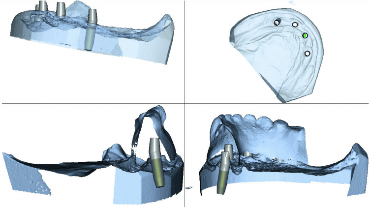 Fig. 7: Design images showing the contour and tooth position of the duplicate denture and proposed design of the Atlantis Conus Abutments.
