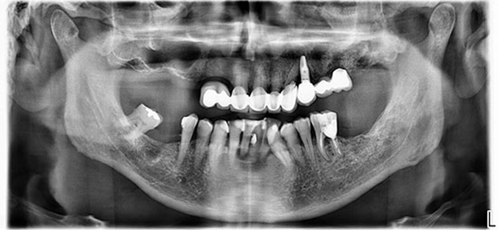 2. En la ortopantomografÃ­a inicial se observa la extensiÃ³n de los voladizos y el grado severo de enfermedad periodontal. Periimplantitis en el implante 24, fractura de 23 y proceso patolÃ³gico en seno maxilar izquierdo debido a un fracaso de una elevaciÃ³n sinusal previa. 