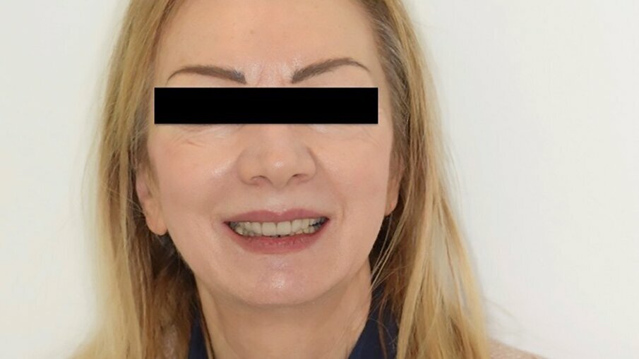 Fig. 13: Perioral aspect of the veneers during smiling.