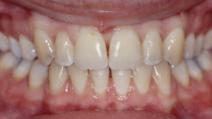 Harmonization of the dento-facial complex