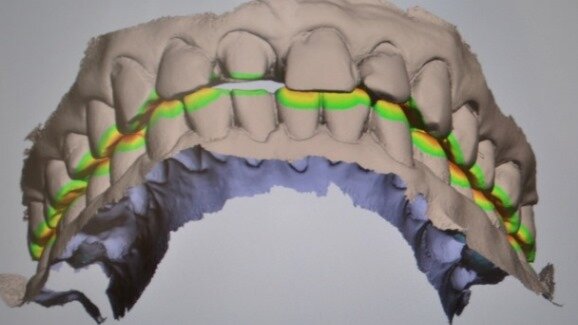 Zastosowanie skanera wewnątrzustnego w praktyce dentystycznej