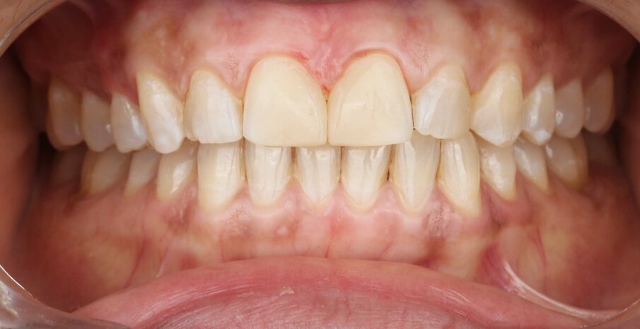 Fig 12. Final smile in Occlusion