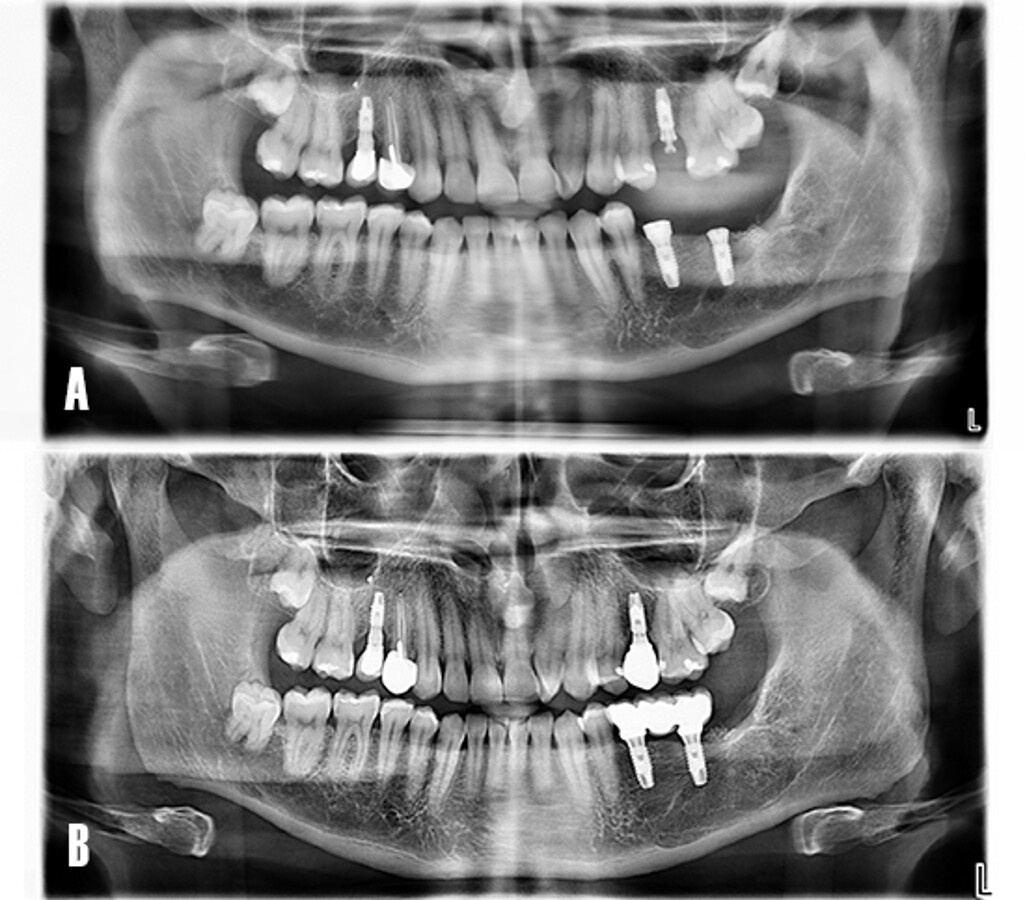Figura 15. OrtopantomografÃ­a. A) DÃ­a de la colocaciÃ³n de implantes. B) A los 24 meses tras la carga funcional de los implantes.