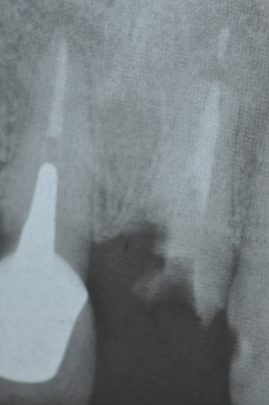 Fig. 2 - Visione radiografica eseguita con un centratore in cui si riscontra l’impossibilità di recuperare la radice per una nuova ricostruzione protesica.