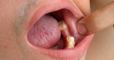 Poor dental health may indicate diabetes risk