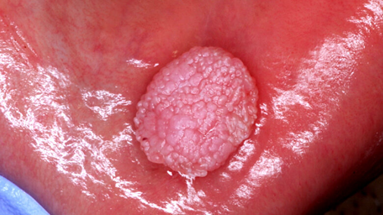 Fig. 1. Papiloma escamoso. Tumor benigno de origen epitelial asociado al VPH que puede aparecer en la mucosa bucal, principalmente lengua, labios y paladar.