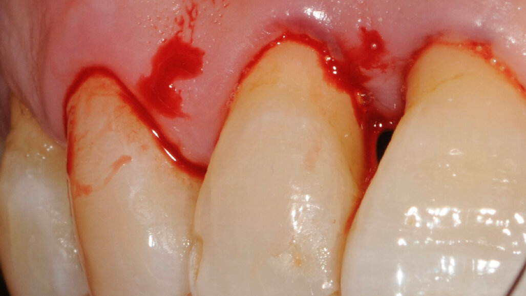 L’applicazione del protocollo  Clean&Seal nel trattamento delle  tasche parodontoli: un case report