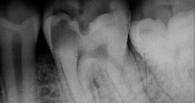 Anatomie du canal radiculaire de la première molaire mandibulaire définitive Implications et recommandations cliniques