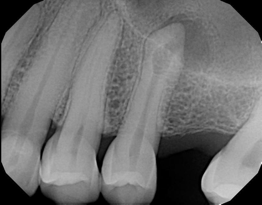 Fig. 16a: Case treated with a Bioceramic master cone, sealer and putty. Note the excellent apical control in this blunderbuss apex. (Courtesy of Dr. Rico Short)