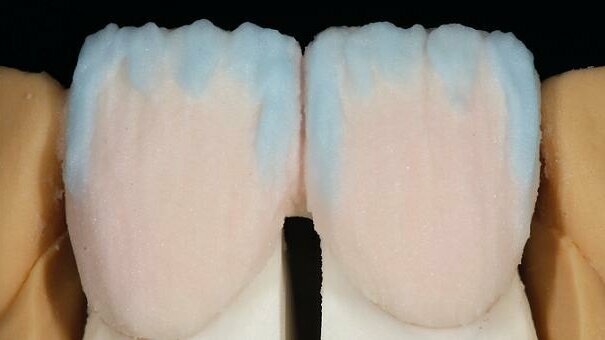 On smile design: Conservatively placed IPS d.SIGN veneers to correct a diastema