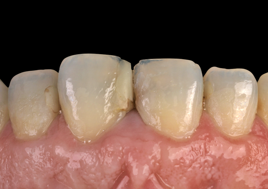 Fig. 1a: Intraoral view before treatment.