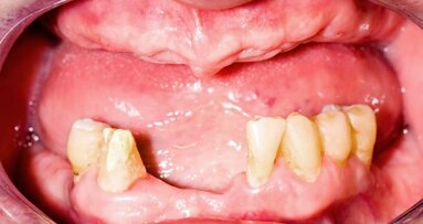 Perda de dente pode ser associada à baixa função cognitiva