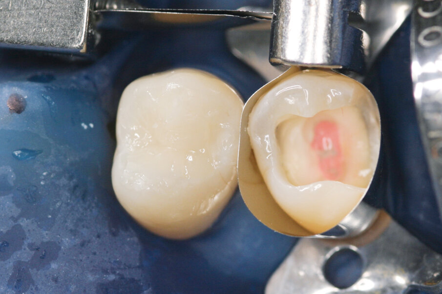 Fig: 7. In this case study a circumferential matrix band was placed around the second tooth followed by the application of Prime&Bond universal™ adhesive. It would be recommended to use a sectional matrix system such as Palodent® V3 for more accurate and contoured contacts. 