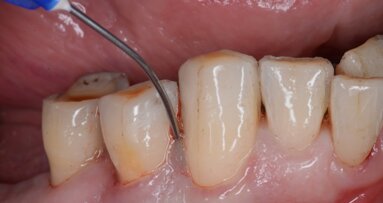 Drei Fragen zur Regeneration parodontaler Knochendefekte
