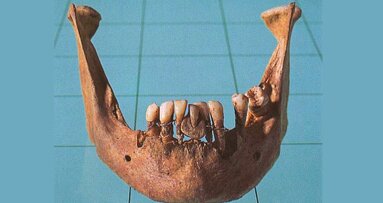 Los “dientes de Waterloo”