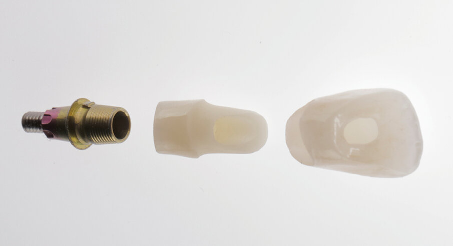Fig. 14. Implant prosthetic restoration