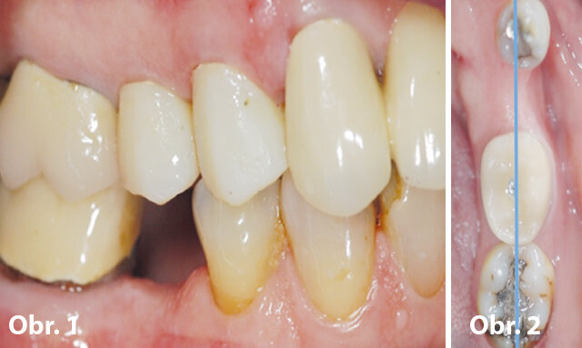 Obr. 1: Klinický stav před chirurgickým zákrokem: chybějící zub 45 / Obr. 2: Klinický stav před chirurgickým zákrokem: bukálně orientovaný dolní první premolár a špičák a lingválně orientovaný dolní první molár