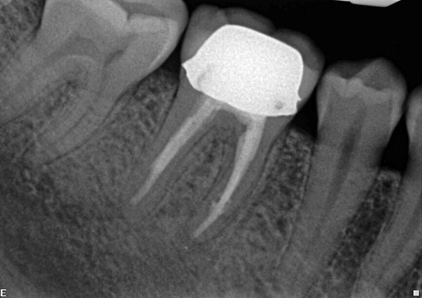 Fig. 8: The follow-up confirms a fast healing of both the apical area and the area of the resorption lesion.