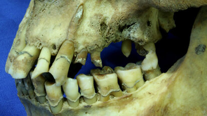 Heavy smoking during Irish famine led to dental caries, study finds