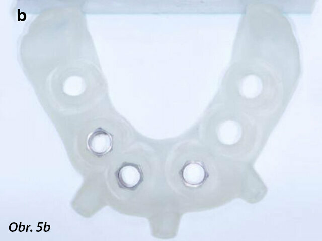Chirurgické šablony vyrobené CAD/CAM technikou: s oporou o zub a sliznici (a) a implantát a sliznici (b).
