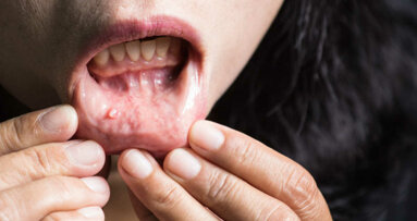 Naukowcy opracowują nową metodę identyfikacji raka jamy ustnej