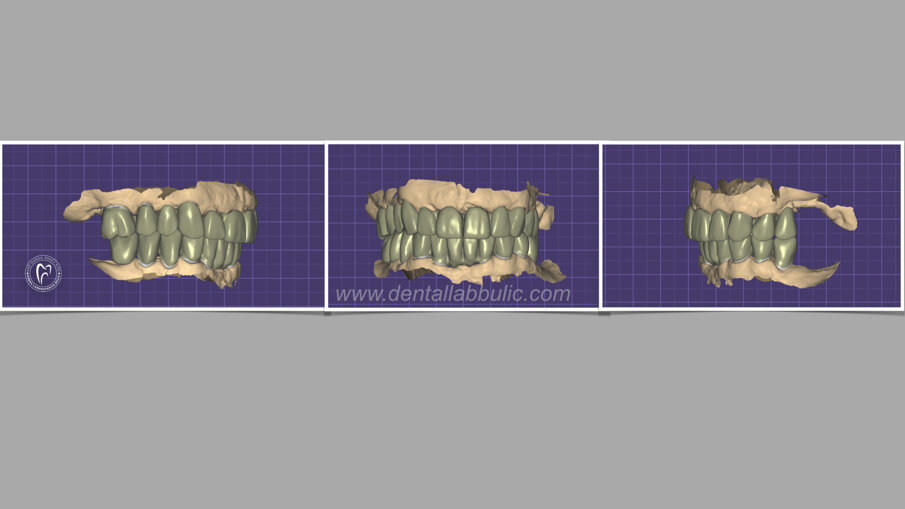 Slika 4 izgled definitivnitivnog dizajna u Exocad – DentalCAD softveru (Zubna laboratorija Bulić)