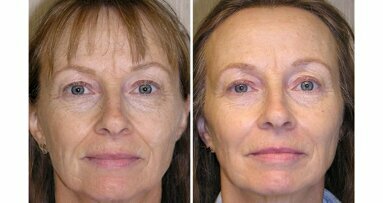 Improving the facial balance in an adult using slow arch development techniques