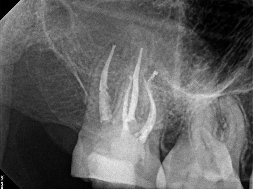 Fig. 13b: Case treated with Chlor-Xtra, SmearOFF with EndoUltra activation. Note the excellent cone fit and apical control of obturation. (Courtesy of Dr. Sam Alborz)