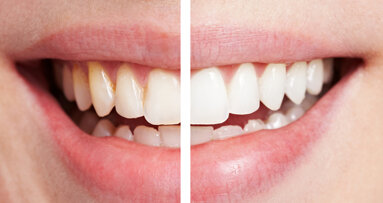 Les bars à sourire ne sont peut être pas le meilleur choix pour un blanchiment dentaire