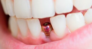 Straumann, Nobel Biocare, DENTSPLY take advantage of growing dental implant demand in Europe