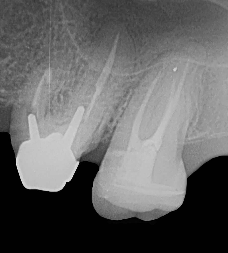 Fig. 18: Radiograph after cementation of the onlay, showing good marginal adaptation and absence of cement excess.