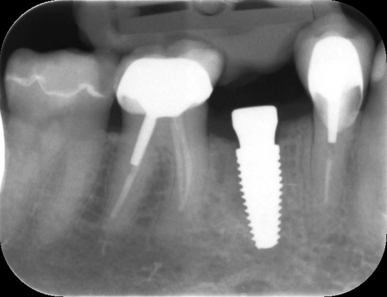 Fig. 4: Radiographie après la pose de l’implant. 