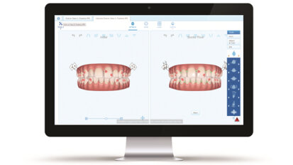 Align Technology expands digital platform with ClinCheck Pro 6.0 and In-Face Visualization