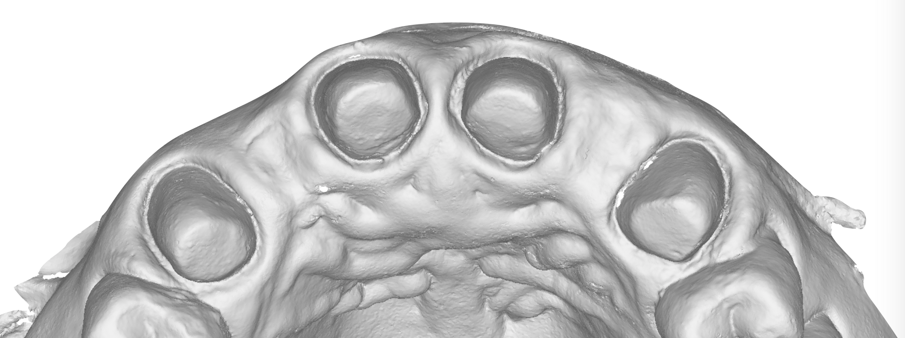 Fig. 20_Collasso dei tessuti nella scansione finale in visione occlusale.