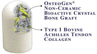 The OsteoGen Plug: One-step bone grafting solution for socket preservation without a membrane