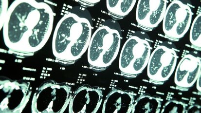 Денталните рентгенови лъчи увеличават риска от доброкачествени, но не и от злокачествени мозъчни тумори
