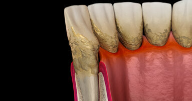 Researchers to develop novel antibiotic delivery system to treat aggressive periodontitis