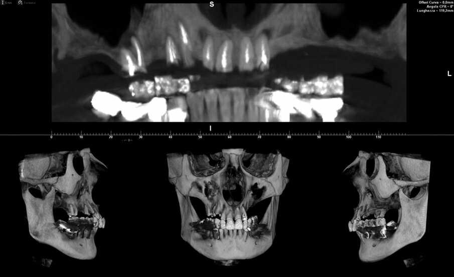 Fig. 1_CBCT e ricostruzione tridimensionale del massiccio facciale della paziente. I sette elementi ancora presenti nel mascellare superiore sono compromessi. 