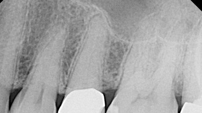 Troubleshooting calcified canals: clinical case review
