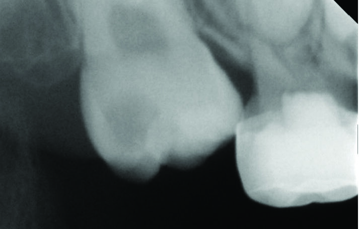 Figure 2:  A periapical radiograph showing ectopically erupted upper right first permanent molar.