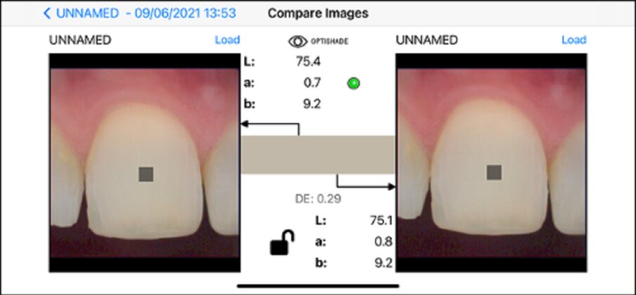 Fig. 11b: Same tooth, same surface (clean), *different time frame, same positioning, same device, same background. Shade difference: 0.29. Reliable measurement. The asterisk indicates the parameter critical to the reliability of the measurement.