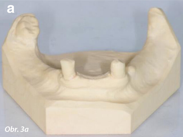 Frontální (a) a okluzální pohled (b) na studijní modely po extrakci zubů