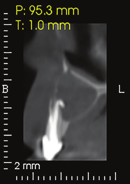 Figure 21: CAT view showing a radiolucent well circumscribed lesion with extended bone loss buccal, palatal and apical.