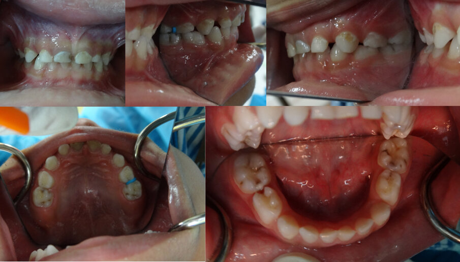 Figures 1 (a, b, c, d & e) are showing typical dental caries in a 3 year old. He had no symptoms whatsoever. In Figures 1 b & d an orthodontic separator can be seen fitted distally to 64.