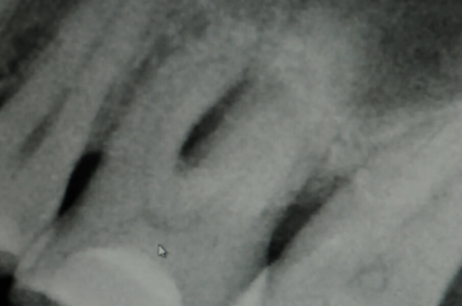 Fig. 5b - Radiografia iniziale 2.6.