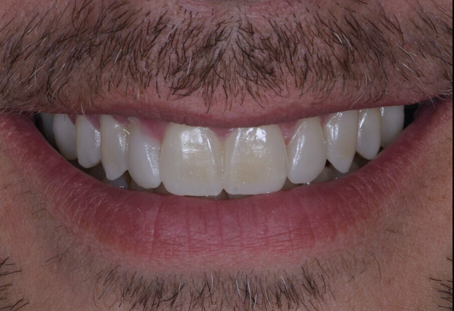 Fig 17: Mockup on 10 teeth